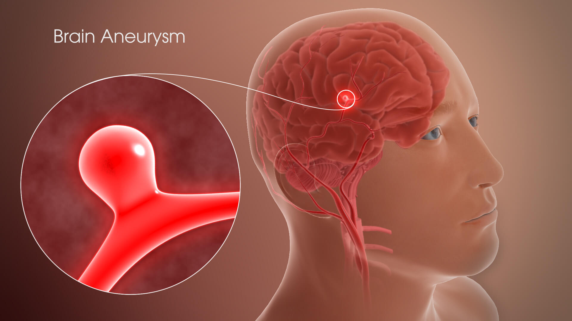 3D Medical Animation Still Shot Showing Brain Aneurysm 1 