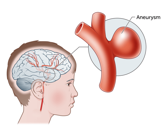 Brain Aneurysm Treatment In Agra