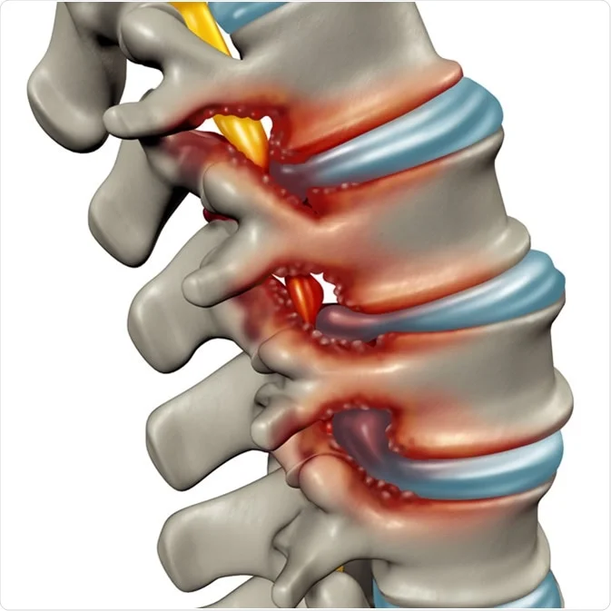 what is Spinal Stenosis | Symptoms & Causes