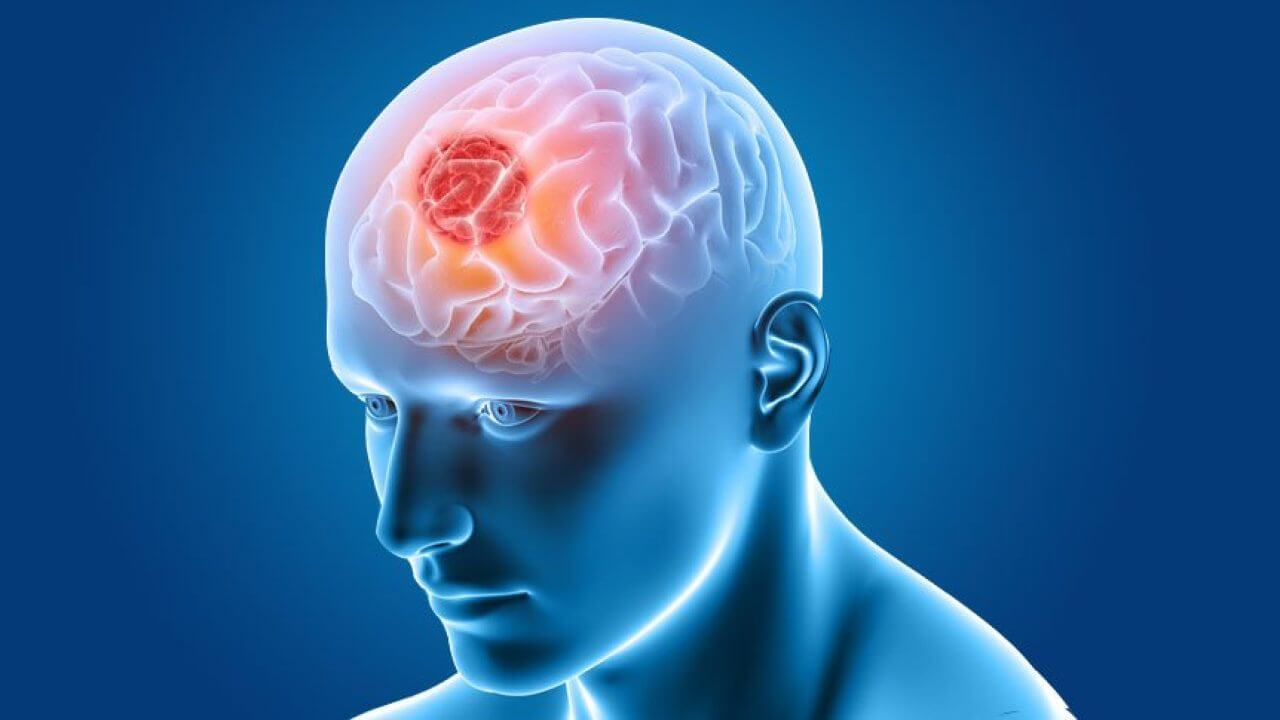 Brain Tumor Awareness Month | Brain Tumor Symptoms & Treatment