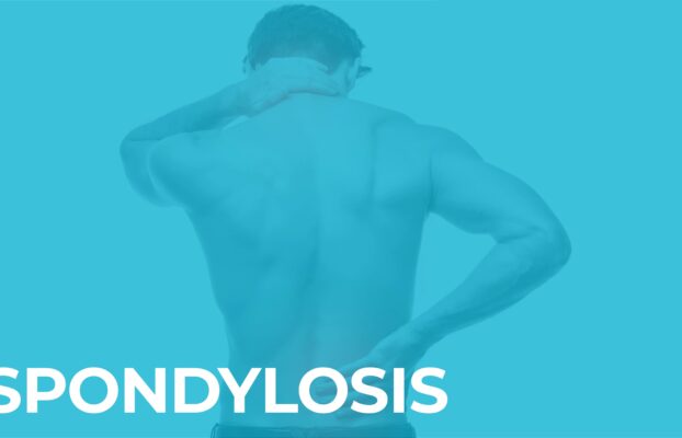स्पोंडिलोसिस क्या होता है? (What is Spondylosis) | स्पोंडिलोसिस का लक्षण और इलाज